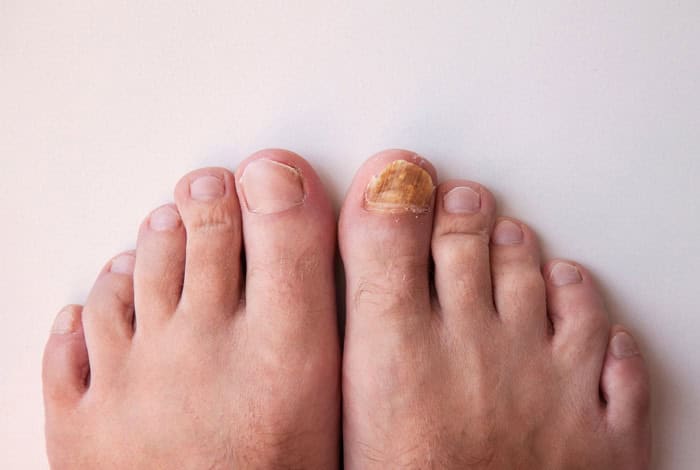 11 Hidden Signs of Liver Health You Can Spot on Your Feet 11 SPB 23