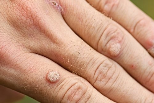 "Quick & Effective Remedies for Skin Tags and Warts" 4 Wart image