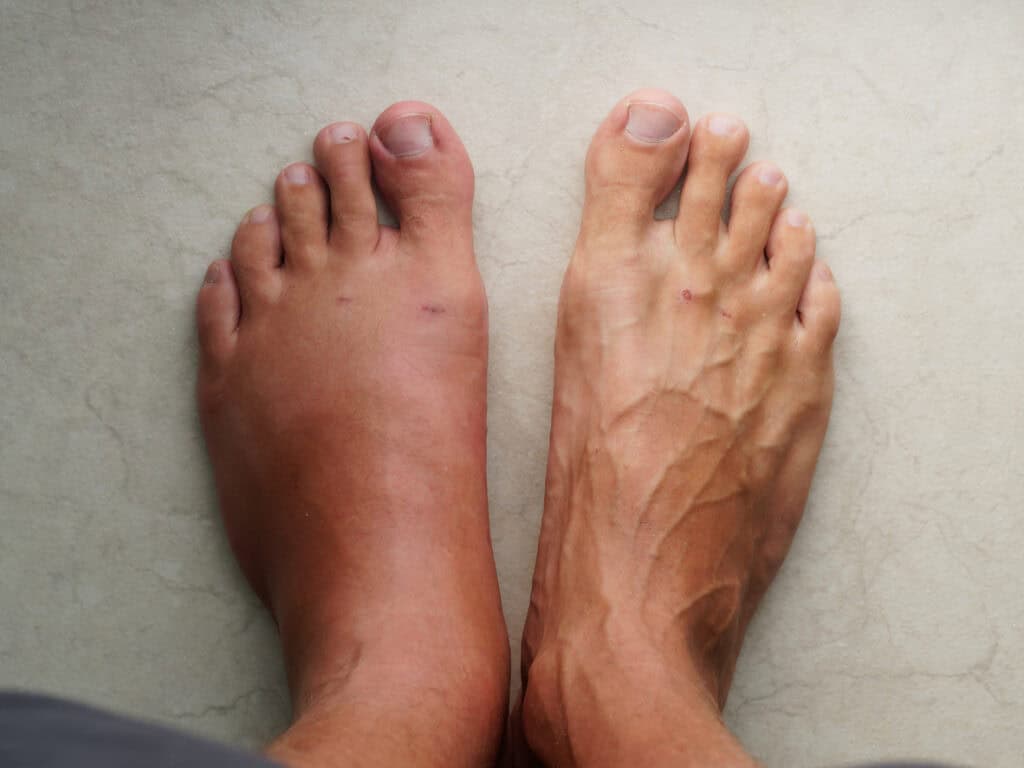 11 Hidden Signs of Liver Health You Can Spot on Your Feet 2 iStock 1263098873