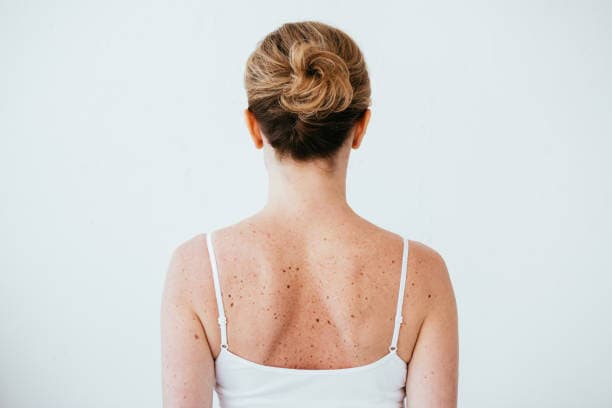 Understanding Skin Cancer: Causes, Symptoms and Prevention 5 istockphoto 1152215981 612x612 1