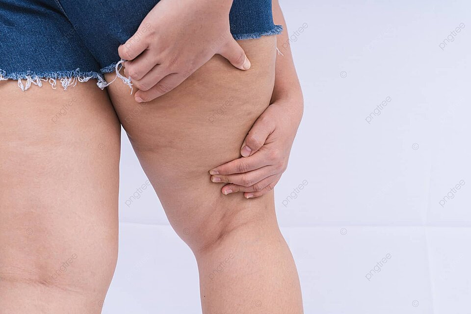 How to Get Rid of Cellulite: New Insights and Proven Strategies 2 pngtree woman holding and compressing the skin of her legs to show cellulite orangepeel texture photo image 32804402
