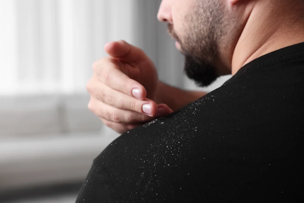 Excessive Dandruff and Zinc Deficiency: Causes, Symptoms and Solutions 2 man with dandruff 1 optimized